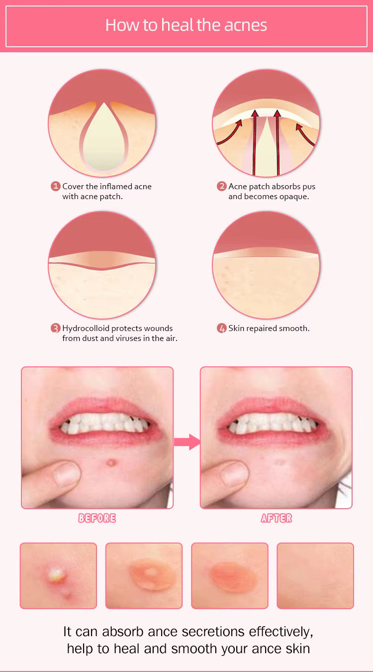 ACNE PIMPLE PATCH